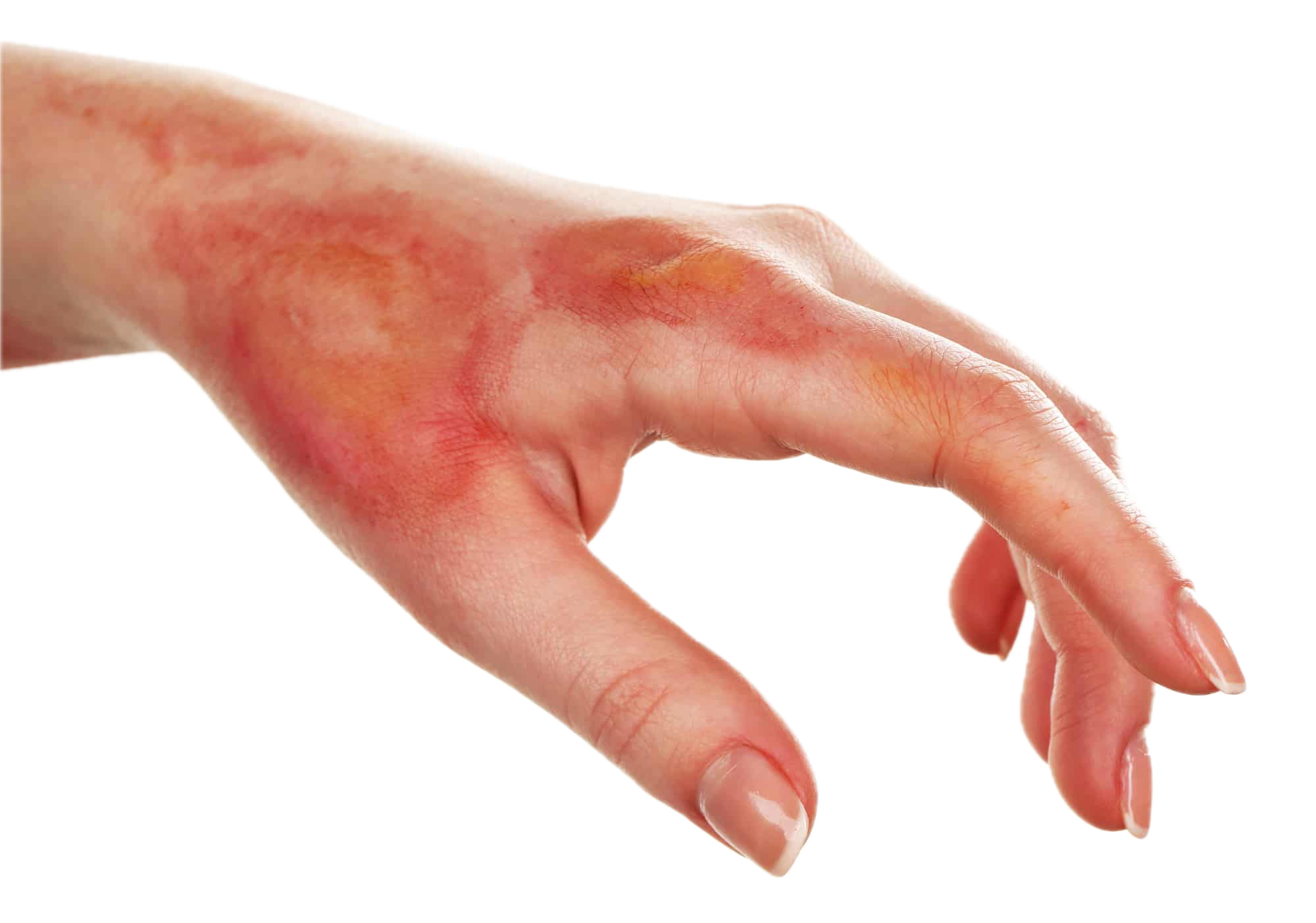 Burn Treatment guidance